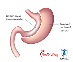 Slider image (2) Obesity Surgical Center | Dr. Jorge Reyes Mendiola
